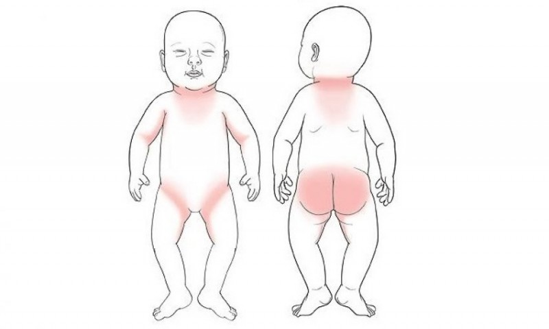 Где бывают опрелости у малыша