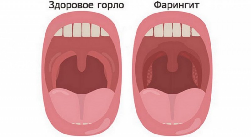 Здоровое и больное горло